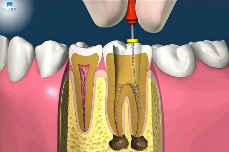 A failed root canal occurs when the treated tooth continues to be infected or shows other signs such as gum inflammation or abscess formation