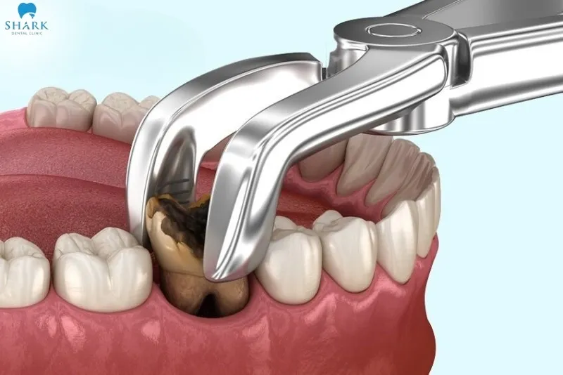 Tooth extraction is an appropriate solution that helps prevent prolonged and spreading infections