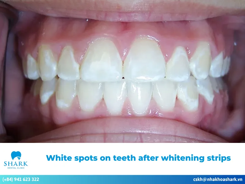 white spots on teeth after whitening strips
