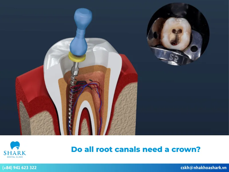 do all root canals need a crown