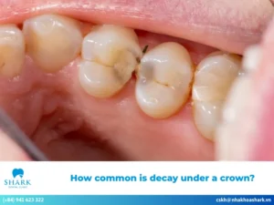 How common is decay under a crown