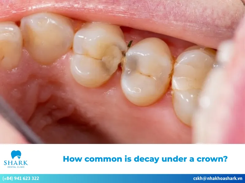 How common is decay under a crown
