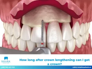How long after crown lengthening can I get a crown