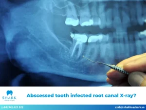Abscessed tooth infected root canal X-ray