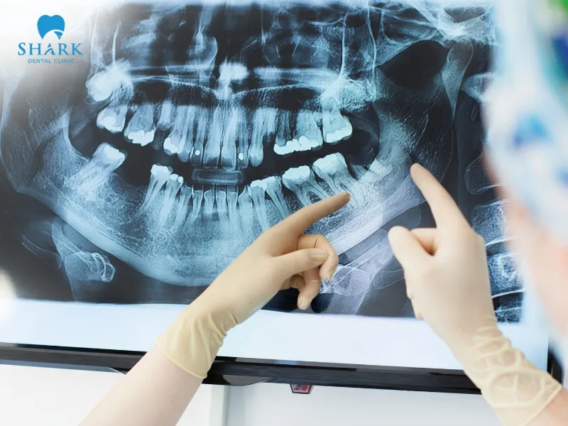 Dental X-rays help identify tooth morphology and provide an overall evaluation of oral health