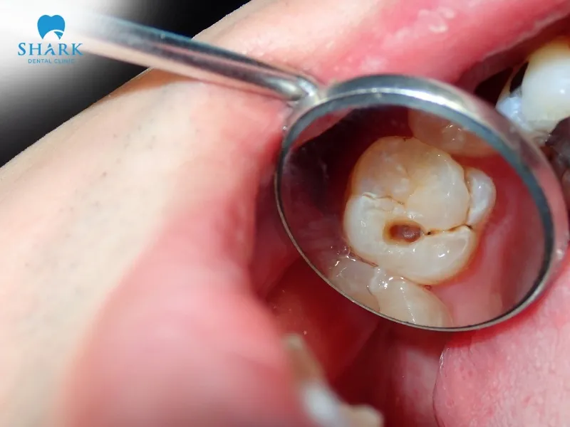 Cavities are often detected on dental X-rays as darkened areas