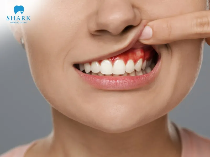 Tooth pain after cleaning may be due to exposed tooth necks