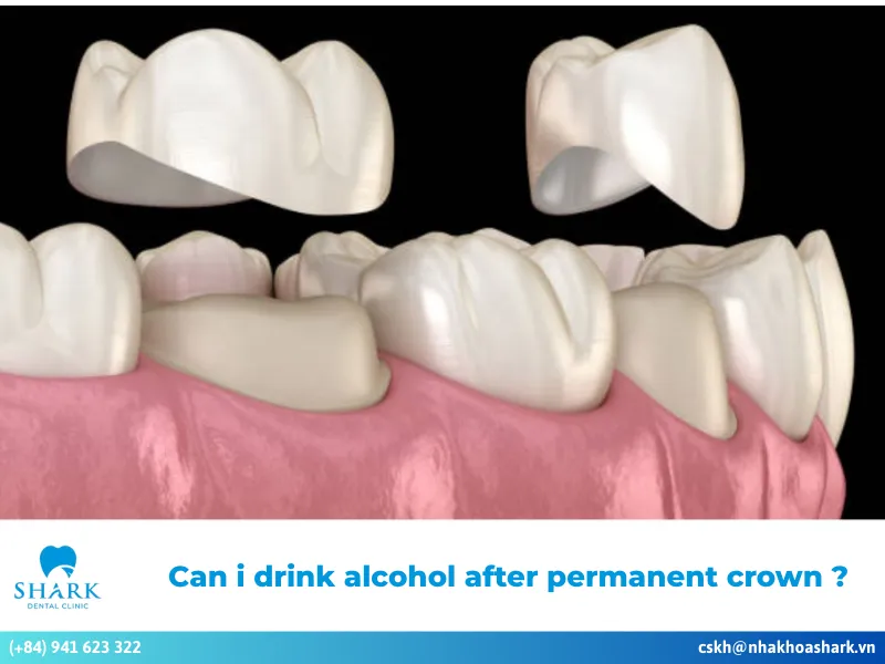 Can I drink alcohol after permanent crown?