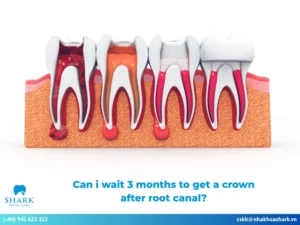Can I wait 3 months to get a crown after root canal?