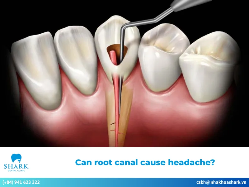 Can root canal cause headache