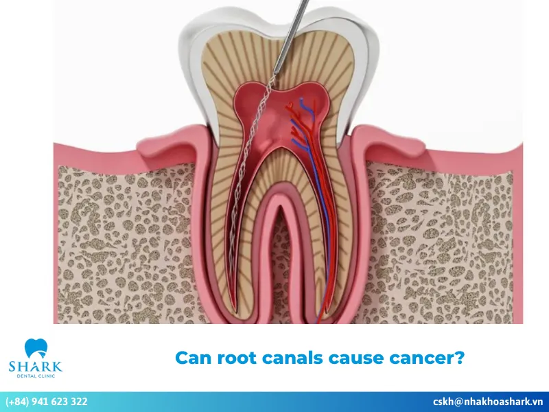 Can root canals cause cancer