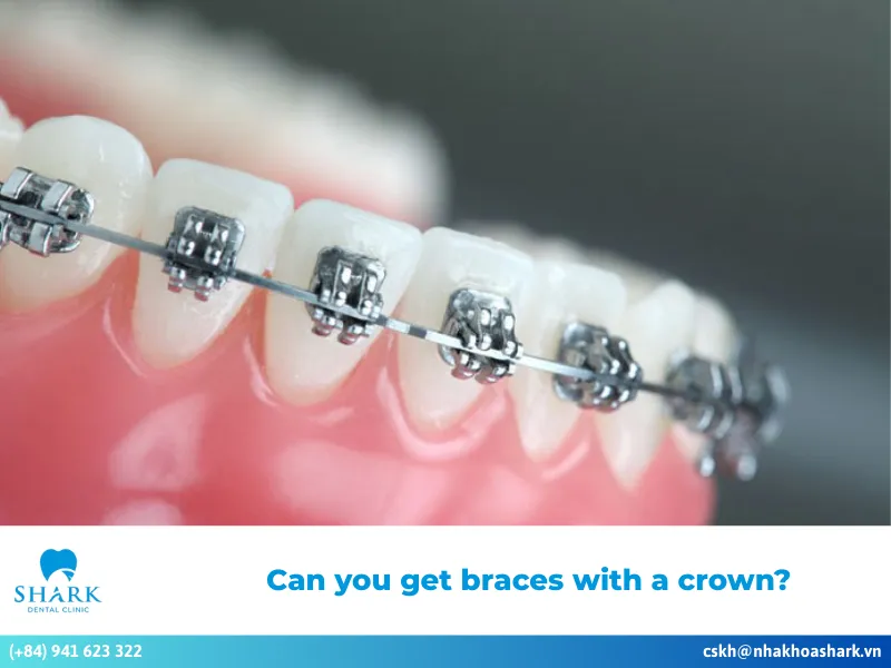Can you get braces with a crown?