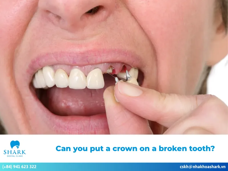 Can you put a crown on a broken tooth