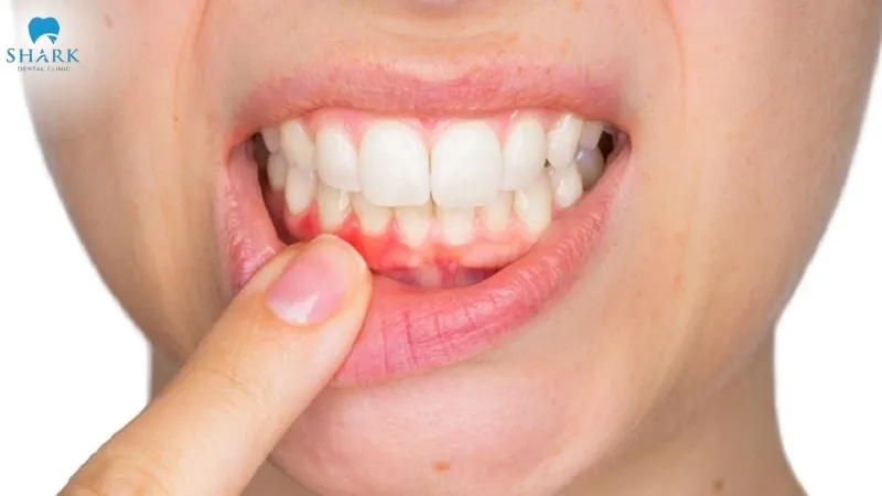 Although dental scaling seems simple, if performed incorrectly, it can still carry potential risks