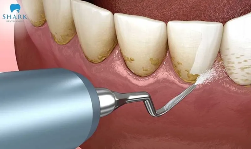 Removing tartar helps keep the teeth bright and beautiful, maintaining confidence when communicating