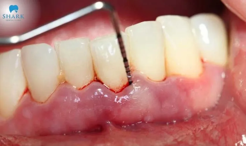 Teeth scaling can damage the enamel and cause slight gum bleeding if performed incorrectly