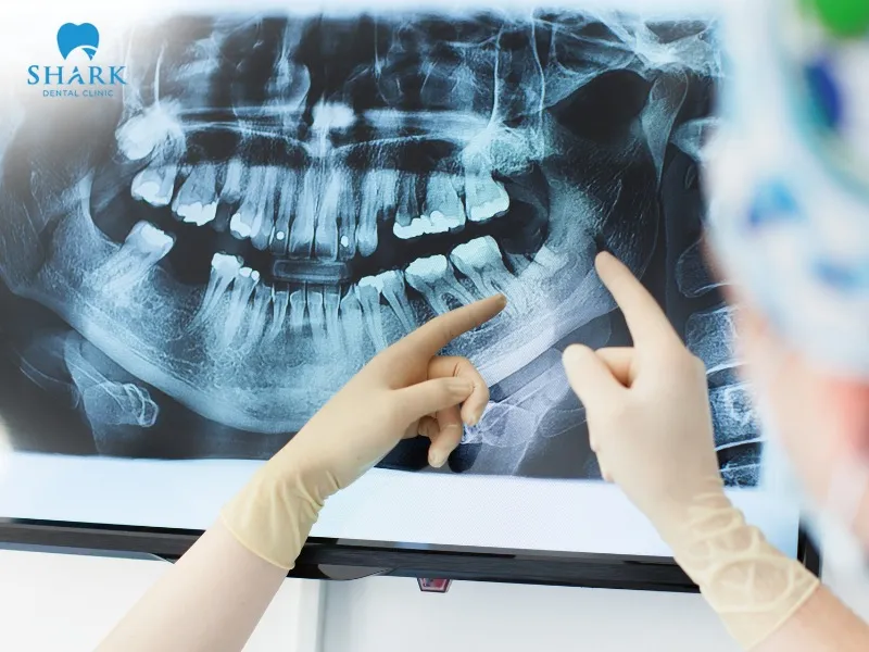After root canal treatment, the X-ray may show changes within approximately 1–3 months or sometimes longer