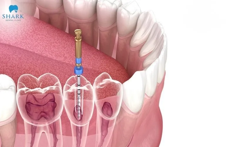 In certain special cases, the crown procedure may not require anesthesia