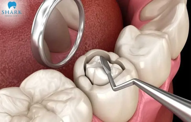 A tooth that has been properly filled and still chews well does not necessarily need a crown, as long as it does not become sensitive or weaken over time
