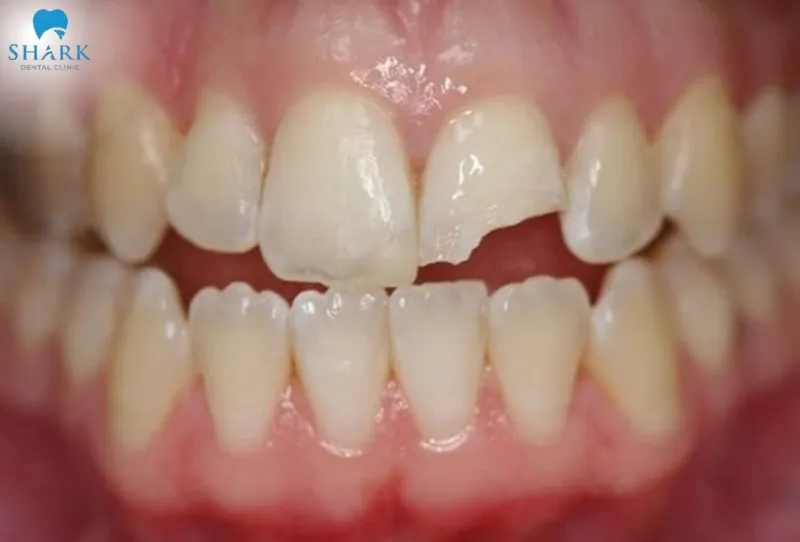 You need to see a dentist immediately when the tooth is severely fractured, exposes the pulp, causes intense pain, or results in continuous bleeding