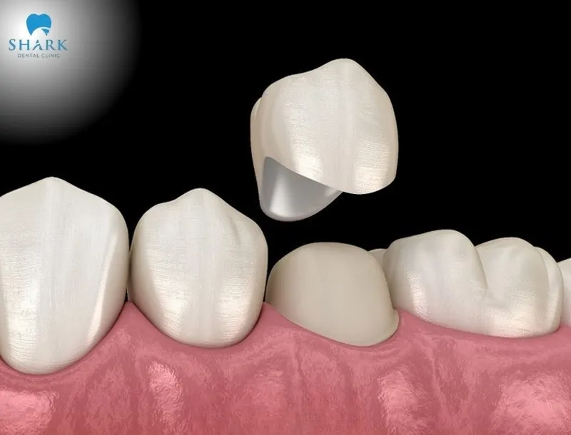 Selecting a suitable dental crown plays an important role in optimizing the restoration outcome, both in aesthetics and chewing function