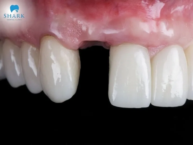 Can you get a crown without a natural tooth? The answer is absolutely yes