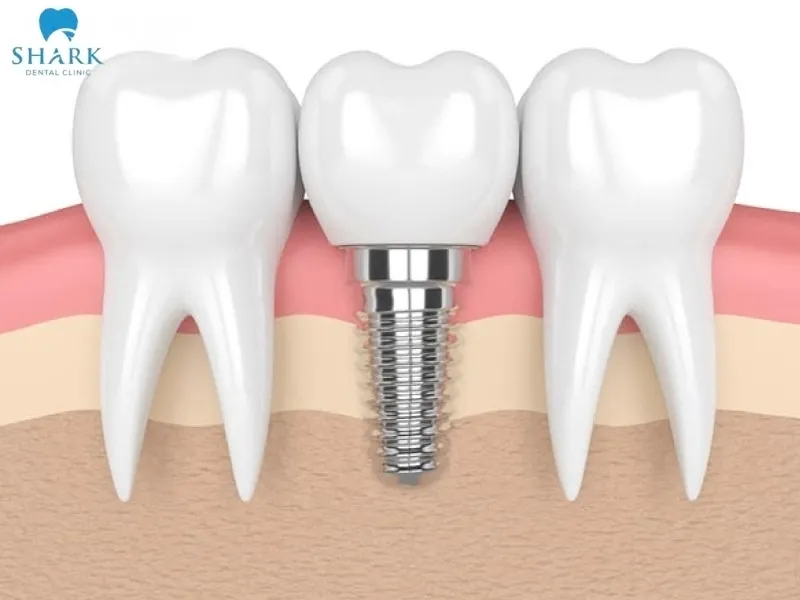 Placing a crown on a dental implant post is a restorative solution that provides long-lasting results and high aesthetic value