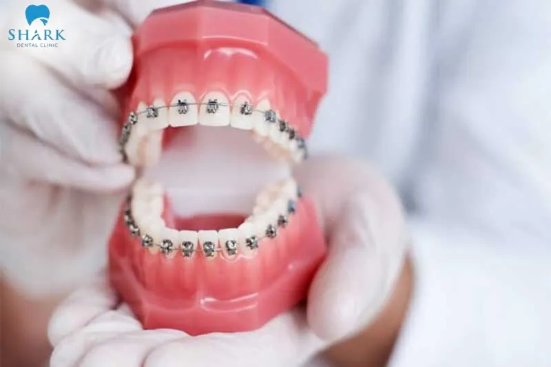 For the question “can you get braces with a crown,” the answer is yes, but it still depends on each individual case