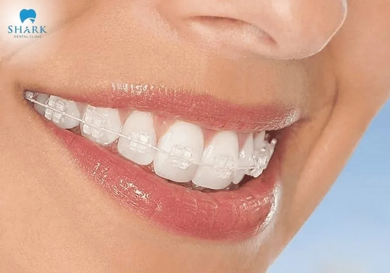  Clear braces on a smile – demonstrating whether you can get braces with a crown.