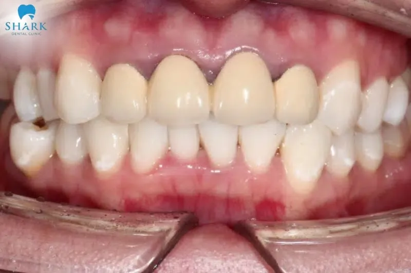 Can you get braces with a crown? You can, but there are also potential risks if the examination is not thorough or if the procedure is performed incorrectly
