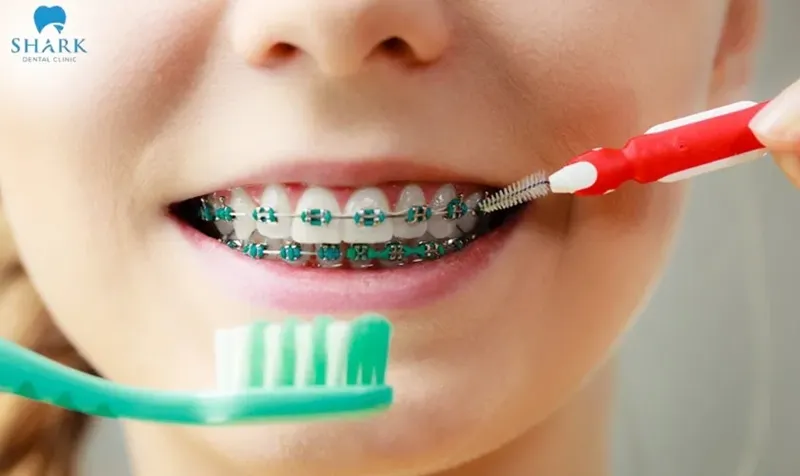 Clean your teeth properly and regularly every day to protect both the brackets and the crowns