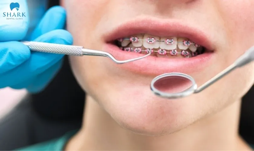 Attend follow-up appointments according to your dentist’s schedule to ensure that both the brackets and the crowns remain stable