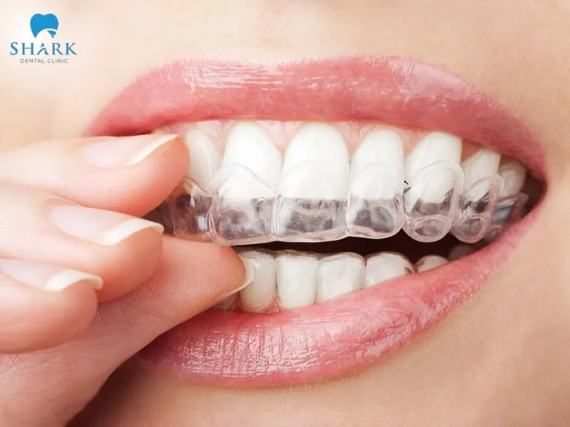 For the question can you get Invisalign with a crown, the answer is yes