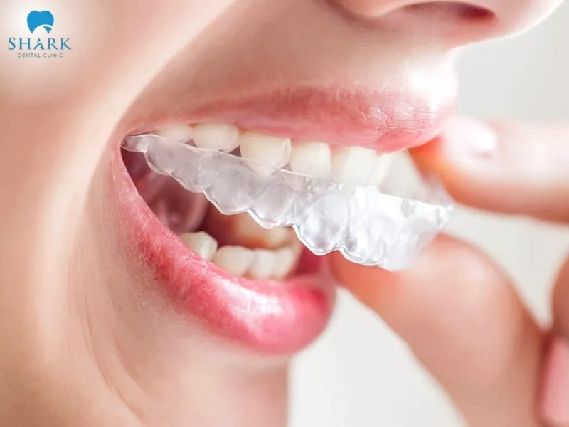 Invisalign treatment for crowned teeth will be more complex than usual because it is influenced by many factors