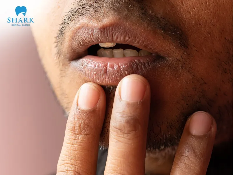 Drinking large amounts of alcohol reduces the natural moisture of the oral mucosa