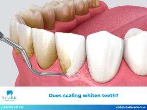 Does scaling whiten teeth?