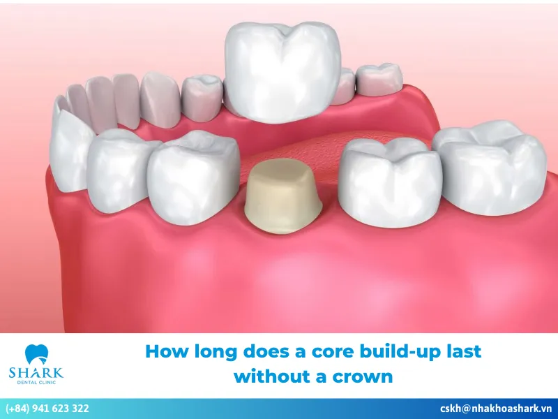 How long does a core build-up last without a crown