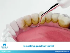 Is scaling good for teeth