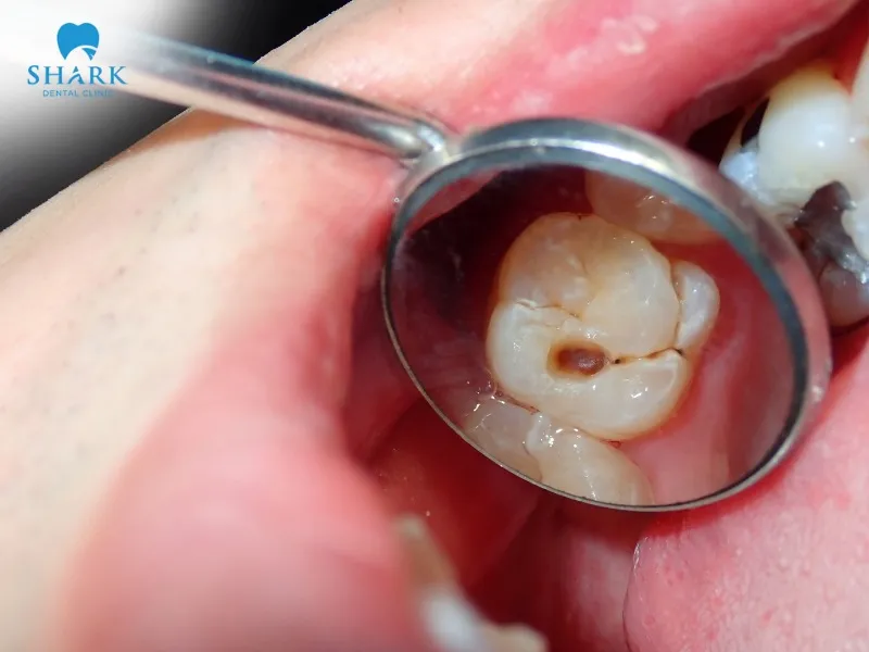 Untreated tooth decay can cause pain and sensitivity