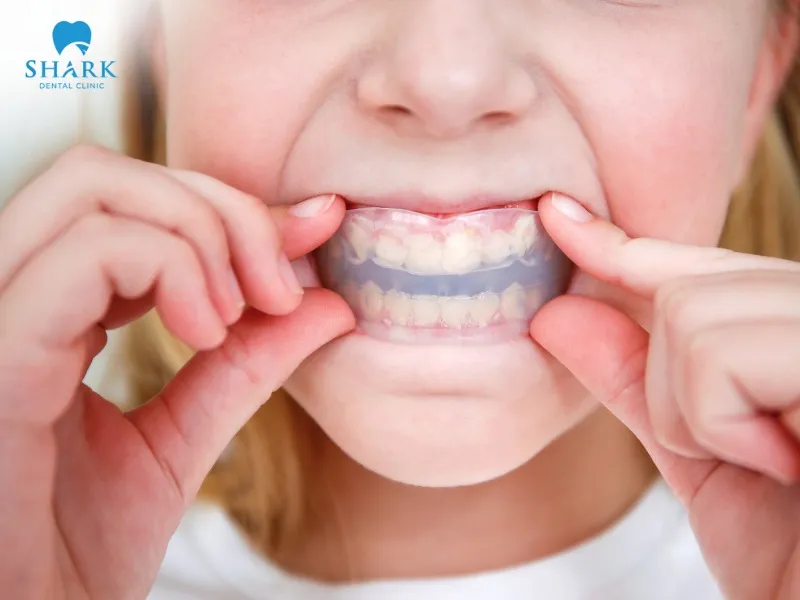 After preparing a tooth, you can wear a protective splint to optimize oral protection