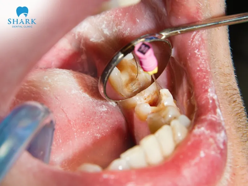 A core build-up can typically last about 1–5 years without a crown, depending on your specific condition