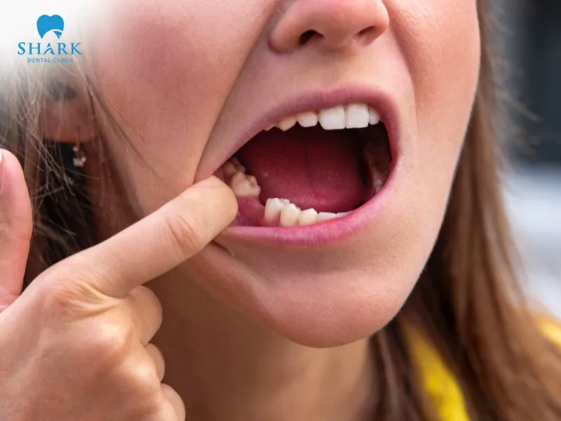 A temporary crown may fall off due to a poor fit, low-quality dental cement, or chewing too hard