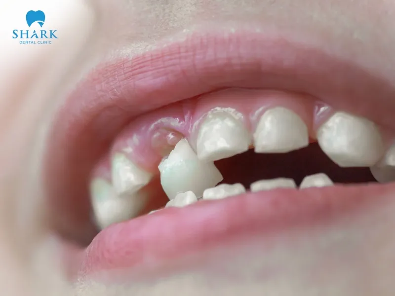 A temporary crown falling off is not considered a dental emergency