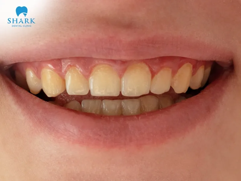 Can I drink alcohol after permanent crown – wine causes discoloration