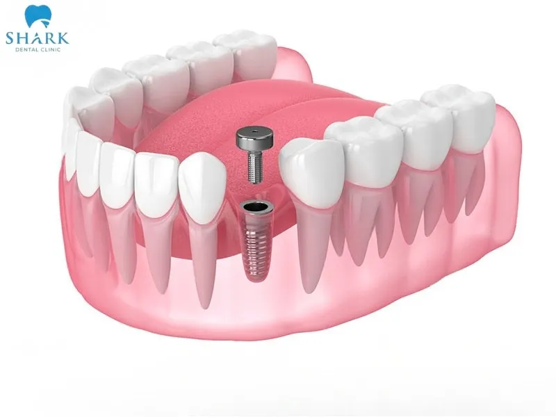 The dental implant healing abutment helps shape the gum tissue and contour the gum area surrounding the implant post