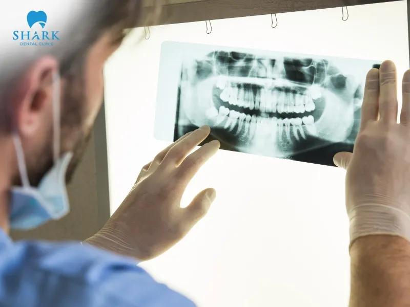 X-ray films help the dentist diagnose suspicious conditions inside the oral cavity