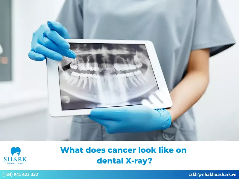 what does cancer look like on dental X-ray