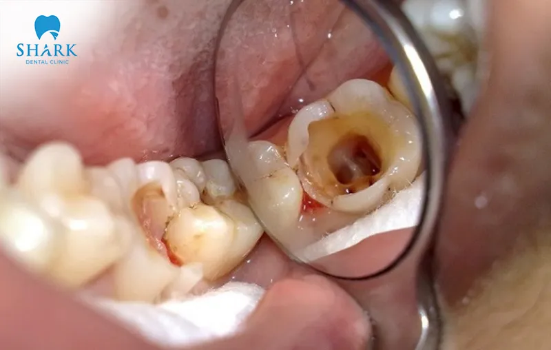 Pre-existing oral health conditions can affect dental crowns and lead to infection after crown placement