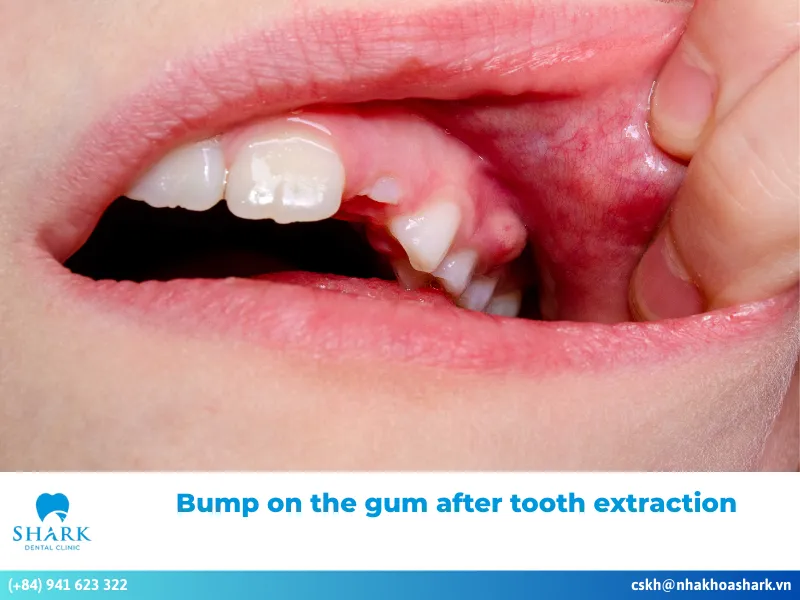 What causes a bump on the gum after tooth extraction?