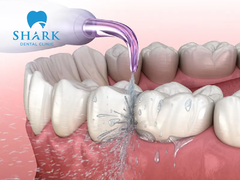 Maintain proper oral hygiene according to dental instructions to prevent the formation of bacteria and plaque